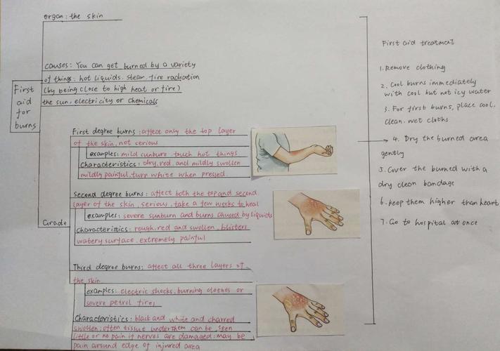 优秀思维导图之b5u5 first aid for burns