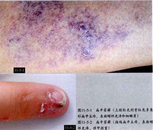 性硬皮病55系统性硬皮病56混合结缔组织病57天疱疮58大疱性类天疱疮59