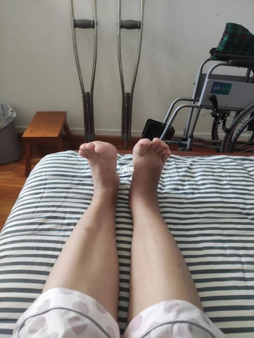 骨折勾脚有变化吗?_日记_骨折日记_医疗健康_医疗健康
