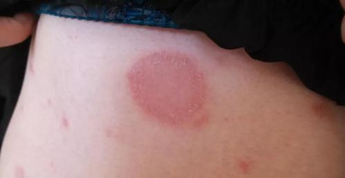 玫瑰痤疮,玫瑰糠疹?这些"玫瑰"可不好看