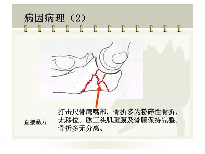 尺骨鹰嘴骨折护理查房.ppt