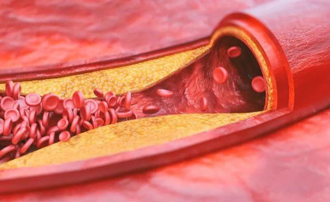 动脉硬化=动脉粥样硬化?这2者间不仅仅是差了2个字那么简单