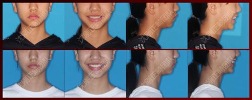 正雅gs隐形牙套矫正亮点概述丨脚踏实地不浮夸,平心静气搞创新