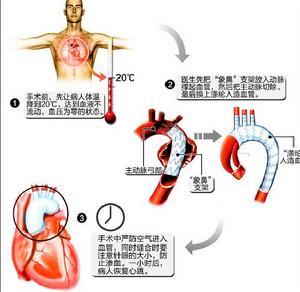 即在深低温停循环下联合全弓置换及支架象鼻技术,是在胸骨正中切口