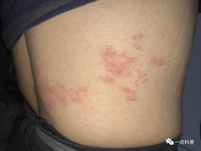 带状疱疹不会缠腰一圈的,更不会死人,所以很多民间偏方简直胡说八道!