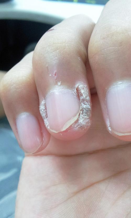 手指皮肤问题,指甲旁边的皮肤长成这样了,扒掉再长也是这样,硬硬的