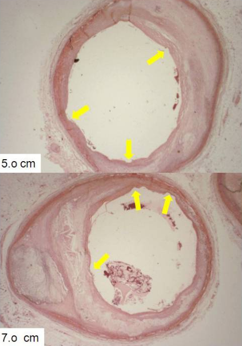 最终,病理诊断包括全身和冠状动脉粥样硬化,缺血性心脏病,急性下壁