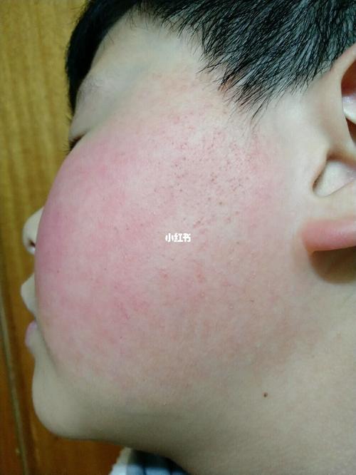 毛周角化(脸发红型)治疗记录第一天_怡思丁怎么样_刷酸_澳洲_博乐达