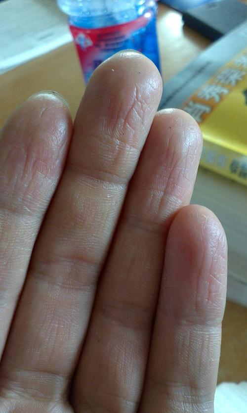 手指头肚这样说明怎么回事?