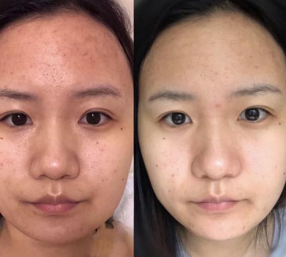 1000次面膜不如一次水光针?来揭秘医美到底有多神奇!