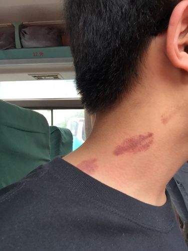 脖子被种草莓好明显大家帮我想一个借口啊 夹子夹的和这个差不多吗