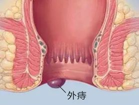 血栓外痔&外痔水肿