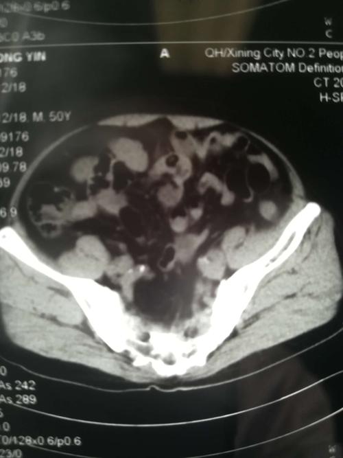 患者中老年男性,诊断:左侧腰疝