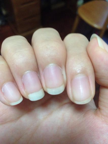 手指甲长出来的部分很白,而且一直都是这样,是怎么回事,看了很多人