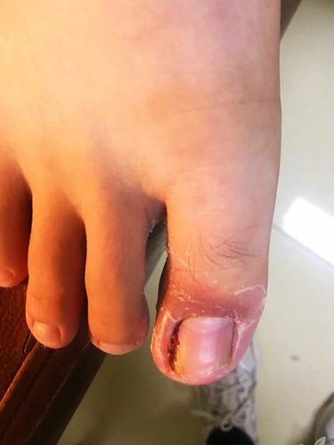 甲沟炎,小毛病,大困扰,有我在,帮您治!