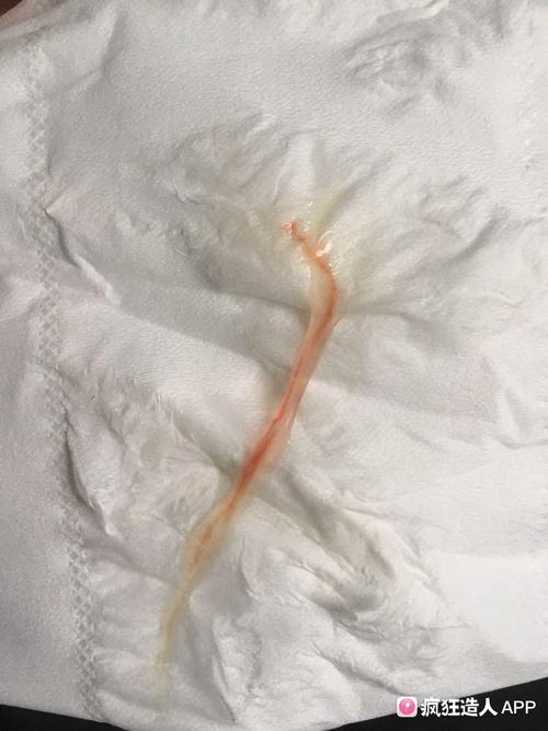 孕21周,同房第二天早上,白带里面有血丝