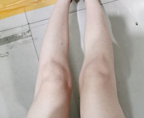 膝盖内侧骨头突出,导致腿不直,这种腿型叫什么,我该如何矫正 2个回答