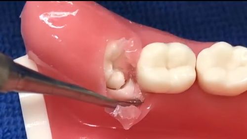 为什么阻生智齿拔除价格会高很多.