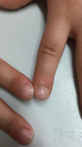 宝宝指甲分层了是缺钙了吗