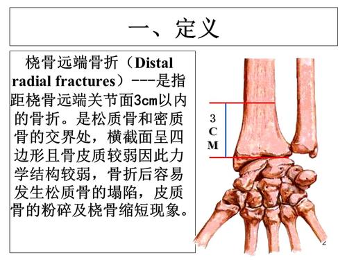 桡骨远端骨折教学查房ppt幻灯片