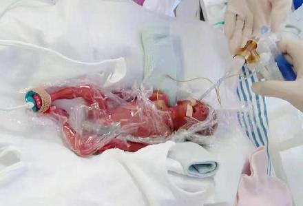 深圳不足1斤超早产儿成功获救 妈妈为孩子取名大力】8月20日,深圳市