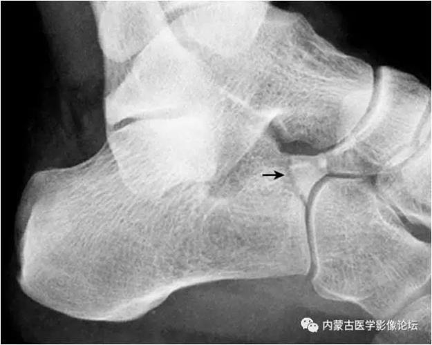 足x线的正常表现及常见病变