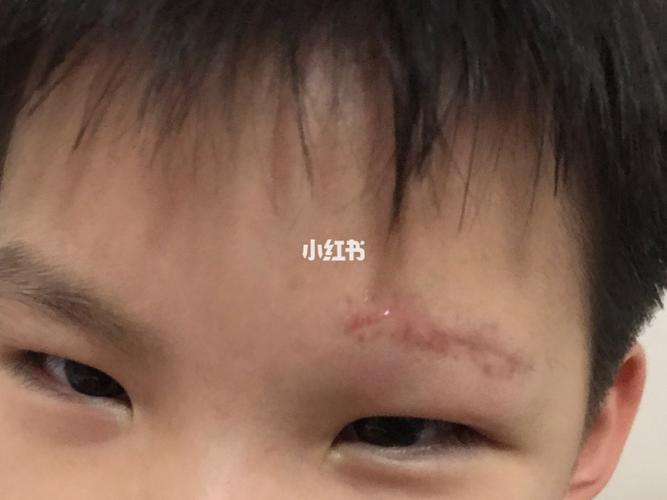 儿童眉毛缝针祛疤_眉毛_祛疤_母婴_育儿经验