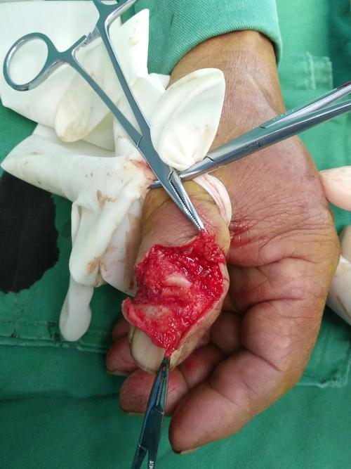 拇指长伸指肌腱断裂