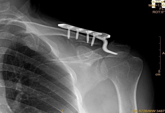 肩锁关节脱位:"3个步骤 9种治疗方法"