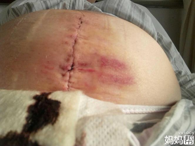 (血腥慎入)剖腹产伤口2天,9天和一个月的区别