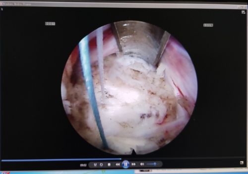 安钢总医院脊柱微创中心首例内镜下纤维环缝合修复术——把腰椎间盘破