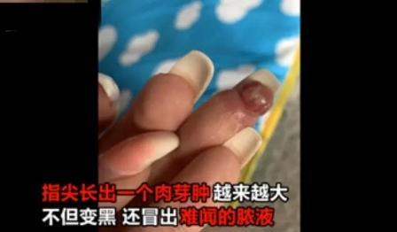 孕妇怀孕做美甲,手指长一节"肉芽",无法哺乳还险些被