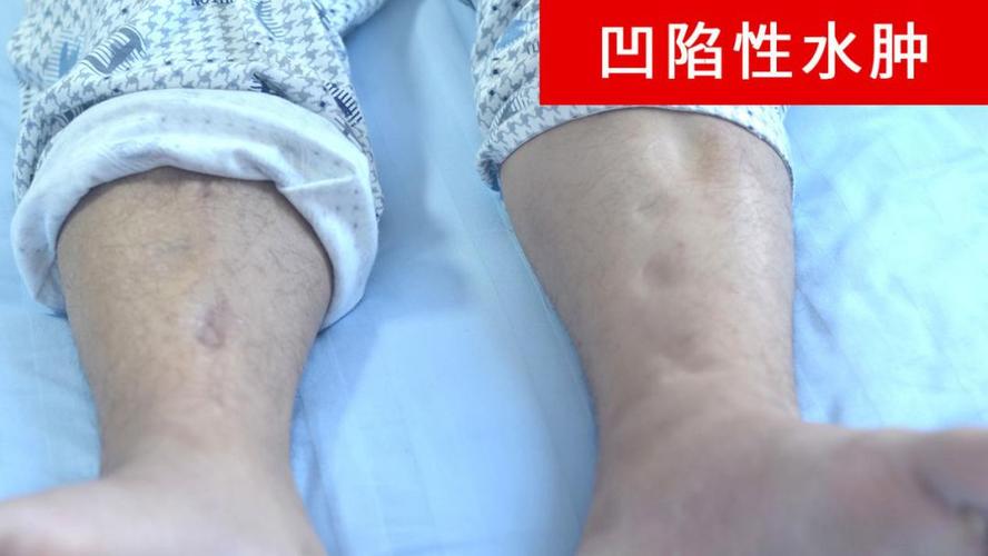 家庭医生是胖还是肿探秘肾病综合征康复密码