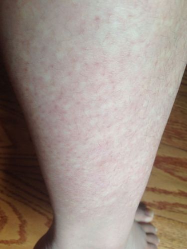 大腿上有这样的白点怎么办 一到夏天就有 用手一抹就没了 原来看了