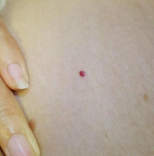 出现蜘蛛痣,是肝硬化吗?这2个时期的女性,也可能出现蜘蛛痣