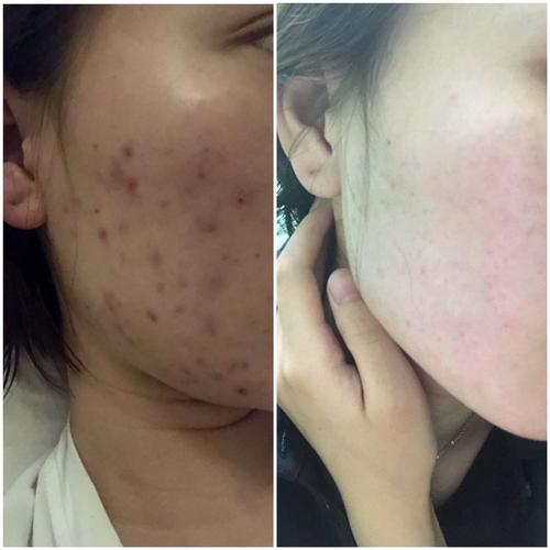 这是我祛痘前后的对比照,是不是像换了个人一样