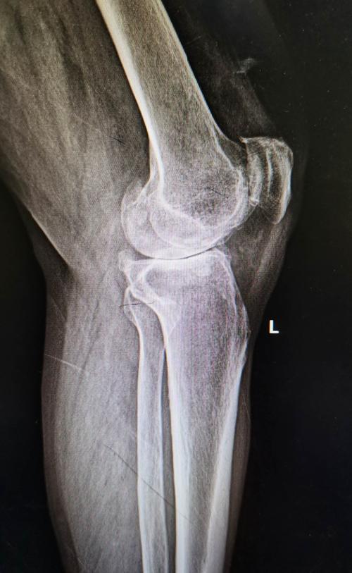 左膝关节活动度约10—130度,右膝关节活动度约15—130度,行走50