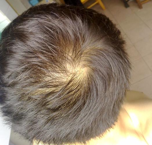 人的头上为什么会长发旋?