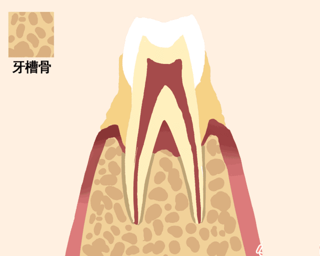 导致牙齿卫生环境愈发恶劣,糖尿病患者逐渐开始发展成为牙齿松动