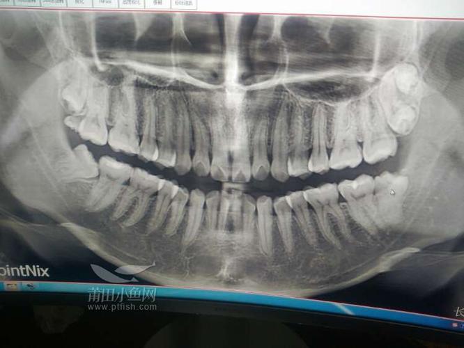 牙齿x光片,会看的大神请进.