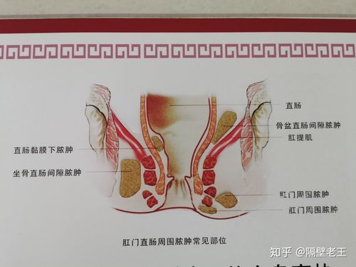 晚上洗澡用手指可以感觉到肛门旁边肉里有肿块