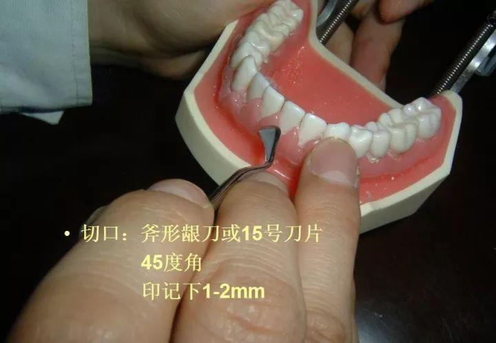 松牙固定术,牙医的必备技能!