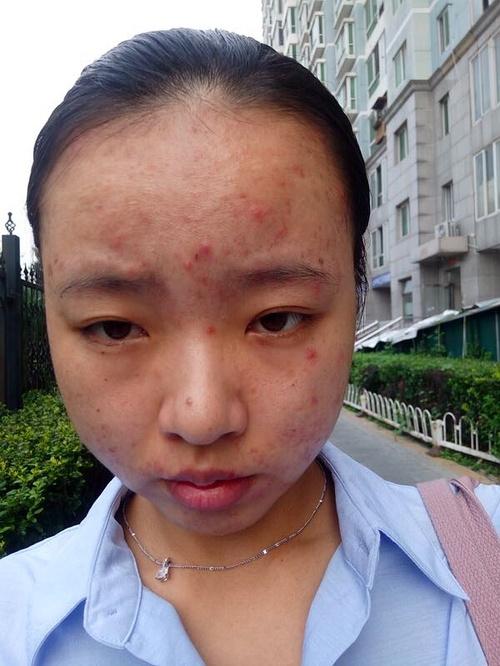 不是骗子,广告勿扰,快被痘痘毁容的脸真的好了,.