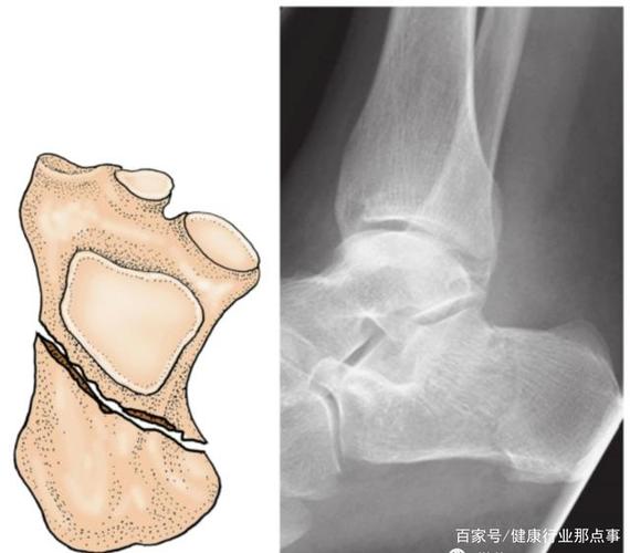 c4≥四部分骨折四,按解剖部位分型a.跟骨前突骨折b.跟骨结节骨折c.