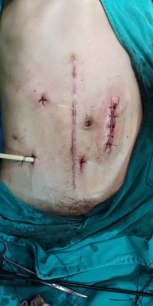 造瘘口还纳成功,患者不在使用人工肛门排便,又可以恢复正常生活.