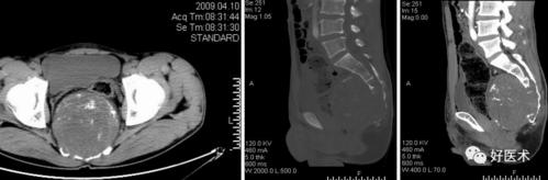 图示 骶尾椎脊索瘤