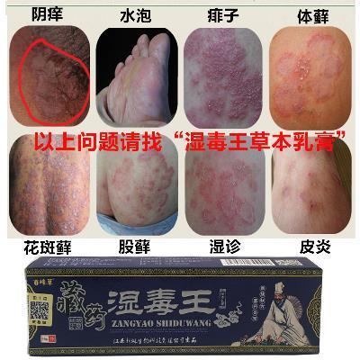 大腿根股癣擦什么药膏股藓用什么药最好我大腿内侧两边得了股藓很痒