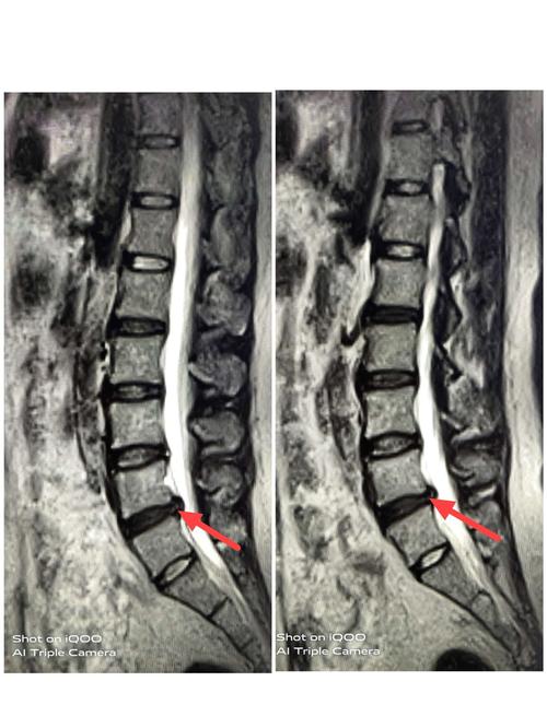 一分钟读懂腰椎间盘突出的影像学表现