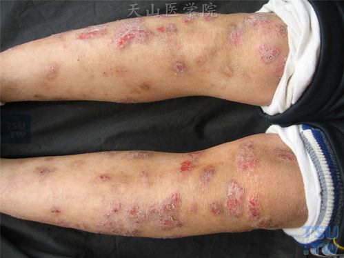 特应性皮炎(atopic dermatitis)的症状表现