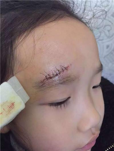 小女孩缝了七针疤痕修复